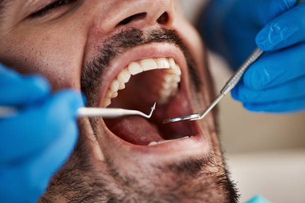 Best Knocked-Out Tooth (Avulsed Tooth) Treatment in Lisle, IL